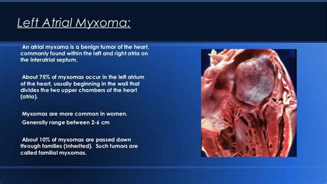 Myxoma powerpoint