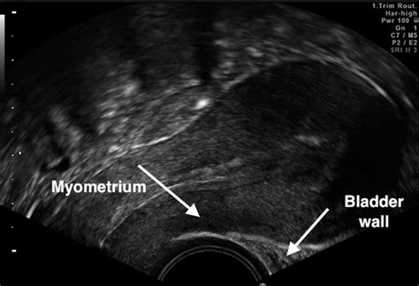 Standardized Approach For Imaging And Measuring Cesarean Section Scars