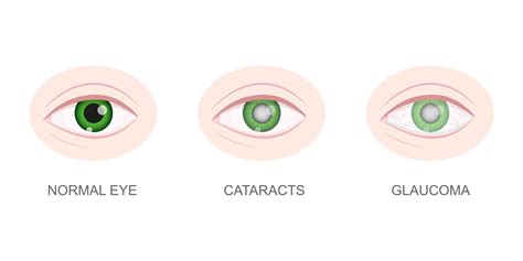 Gezond Cataract En Glaucoom Oog Detailopname Visie Oogbol Met Normaal