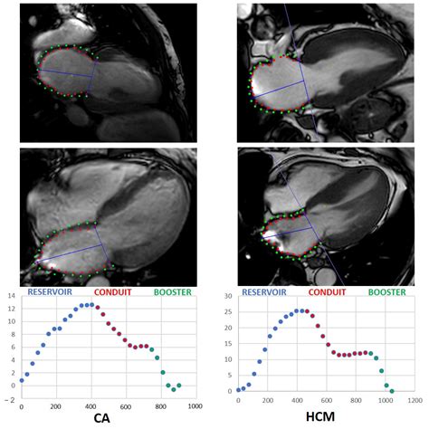 Jcm Free Full Text Magnetic Resonance Imaging Based Left Atrial