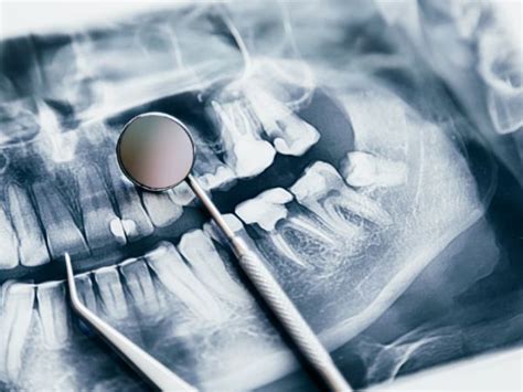 Qu Es La Radiolog A Digital Para Odontolog A Clinica Dental Seis