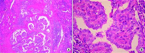 Microscopic Findings Of Thyroid Cancer A A Classical Papillary