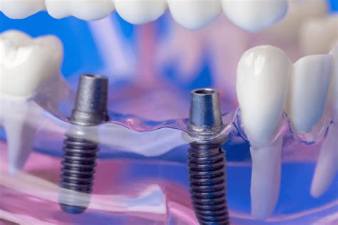 Dental Bridges Malaysia Types Procedures Cost