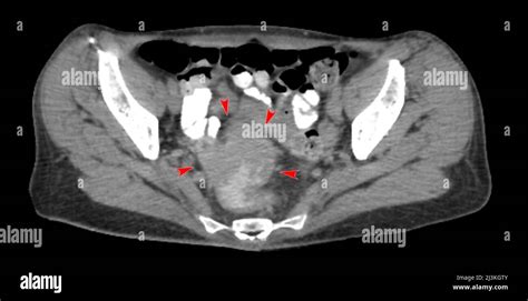 Colorectal Cancer Xray Hi Res Stock Photography And Images Alamy