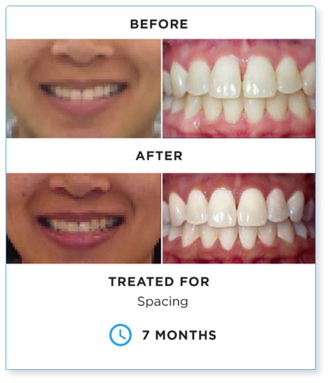 SureSmile before and after: See the difference! | SureSmile