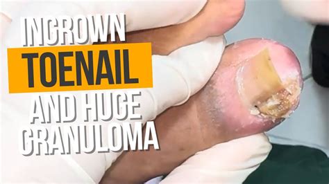 Ingrown Toenail With Huge Granuloma Ingrown Toenail Removal YouTube