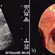 a) Right lower paratracheal lymph node. The tip of the needle is shown ...