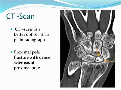 Avascular Necrosis Of Scaphoid