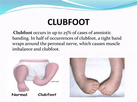 Amniotic Band Syndrom Epptx Ppt