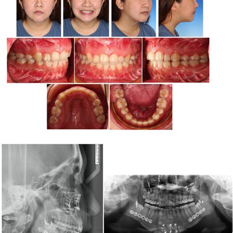 A The Pretreatment Extraoral And Intraoral Photographs Showing