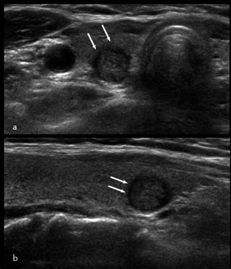 Follicular Thyroid Cancer Ultrasound