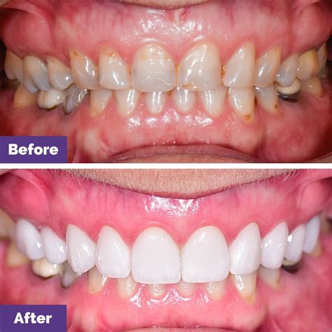 Before After Gallery Bacchus Marsh Dental House