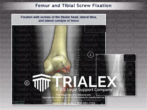 Femur and Tibial Screw Fixation - TrialQuest Inc.