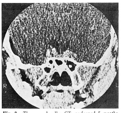 [PDF] Spontaneous rupture of intrasellar cyst demonstrated by CT and MR ...