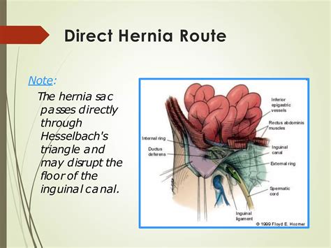 Inguinal hernia repair surgery dr valeria simone southlake general