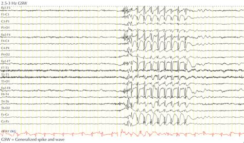 JLE Epileptic Disorders Characterizing Sunflower Syndrome A