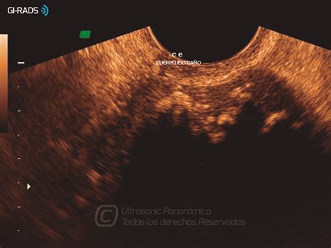 Patolog As Benignas Patolog A Extra Ginecol Gica Gi Rads