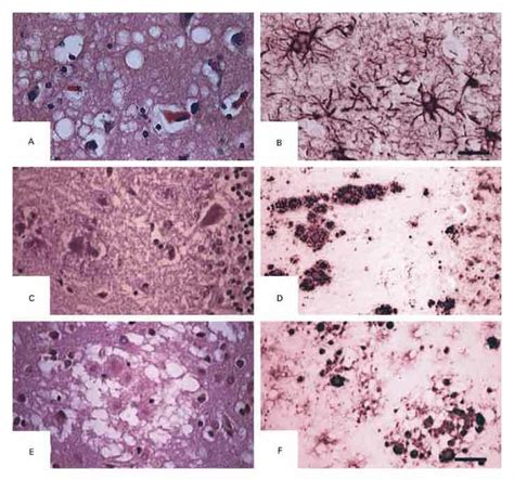 Neurodegenerative Diseases And Prions Nejm