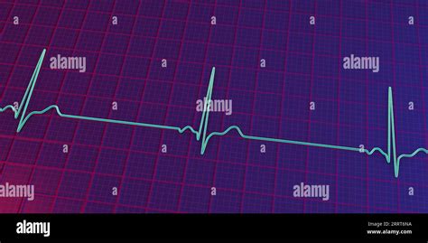 Bradicardia Electrocardiograma Fotograf As E Im Genes De Alta