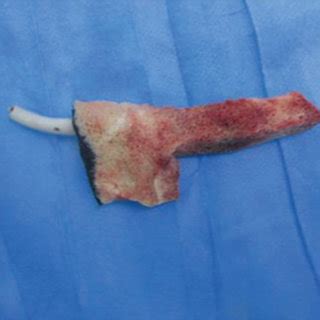 Percutaneous Screw Fixation With Transforaminal Debridement And Vacuum