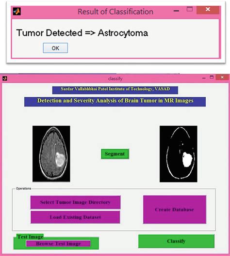 7 Correct classification of astrocytoma tumour [25] | Download ...