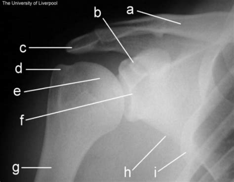 Diagram X-Ray of AP Shoulder Diagram | Quizlet