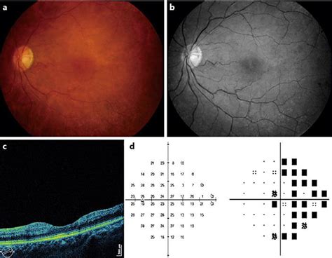 Figure From Combined Central Retinal Artery And Vein Occlusion