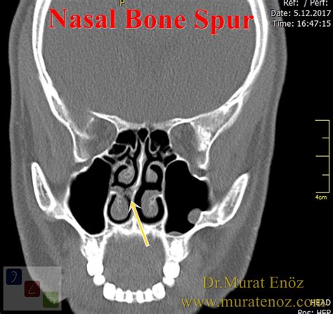 Health Zone Turkey Nasal Bone Spur Symptoms Diagnosis Treatment