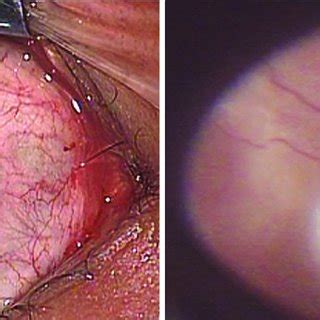 Intraoperative Photography Showing Chandelier Light In Place A And