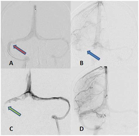 Case 2 Ap Venogram Demonstrating A Stenosis Red Arrow Of The Download Scientific Diagram