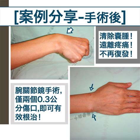 腱鞘囊腫 Ganglion Cyst手腕疾病專欄手外科醫師