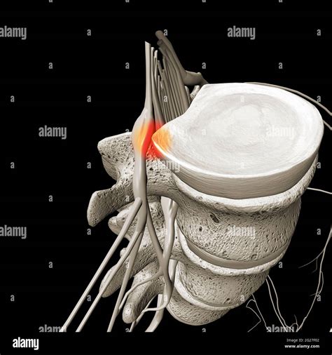 Spinal Nerve Roots Hi Res Stock Photography And Images Alamy