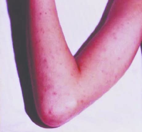 Typical Rocky Mountain spotted fever rash. Image obtained from the CDC ...