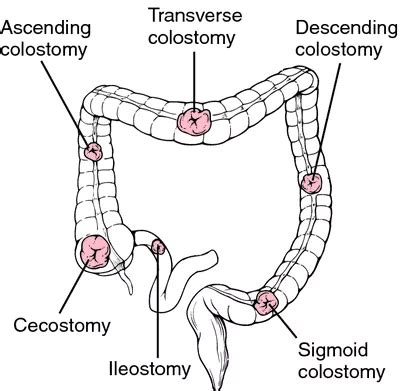 Intestinal stoma care