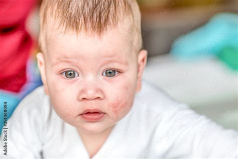 Atopic Dermatitis Eczema In Baby Condition That Causes The Skin To