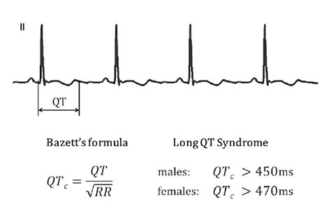 Long Qt Syndrome Ecg Pattern