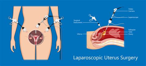 Uterus Laparoscopic Surgery