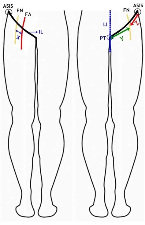 Figure 1 From A Guideline For Femoral Nerve Block With The Age Related