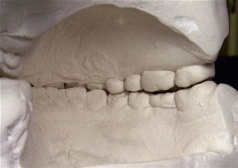 18. Use of Articulators in Occlusal Therapy | Pocket Dentistry