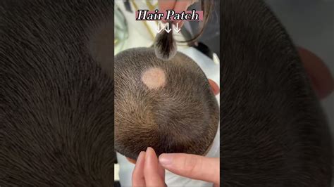 Cover Bald Spots On Head Sides Or Back For Men Or Women Hairpatch Hairlosstreatment Youtube