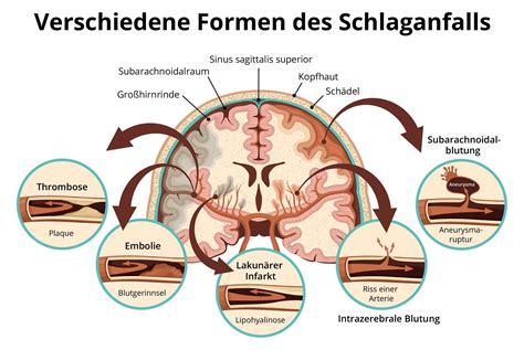 Was sind Symptome einer Hirnblutung bei Männern und Frauen