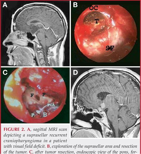 Suprasellar Meningioma Semantic Scholar