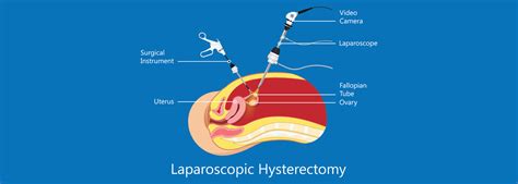 A Complex Case of laparoscopic hysterectomy - RBH