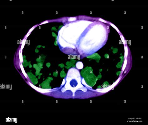 Ct Der Metastatischen Lungenerkrankung Fotos Und Bildmaterial In