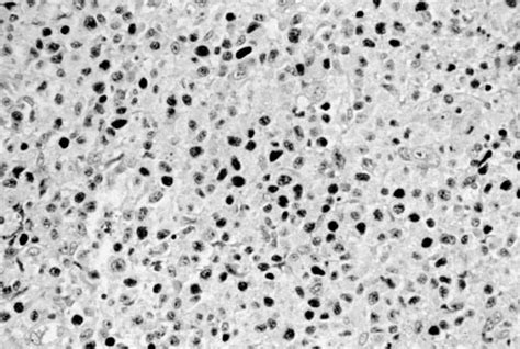 Identification Of Epstein Barr Virus In Situ Hybridization For Download Scientific Diagram