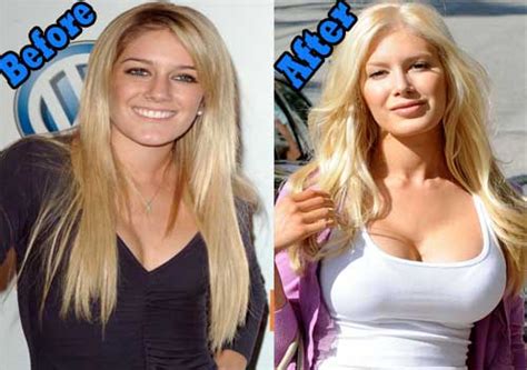 Heidi Montag Before and After Plastic Surgery