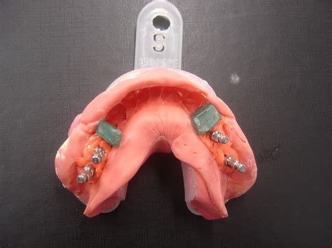 Vaciado De Modelos De Implantes Apuntes De Pr Tesis Dental