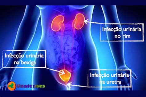 Unaienses A Infecção Urinária