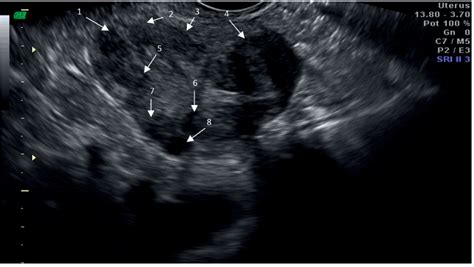 Uterus Fibroid Ultrasound