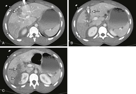 Hepatic Trauma Surgery And Liver Directed Therapy Radiology Key